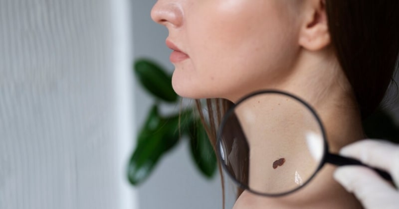 Ruqyah healing skin cancer